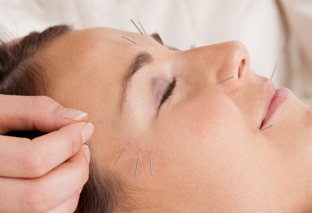 Can Facial Acupuncture Stimulate The Production Of Collagen, White Crane Clinic