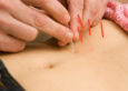 what-can-acupuncture-do-for-weight-loss