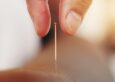 what to expect after acupuncture treatment