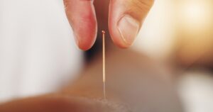 What to Expect After Acupuncture Treatment