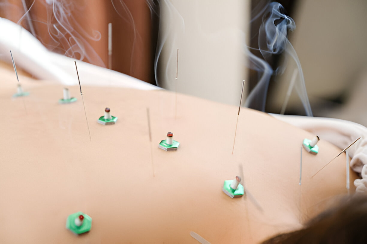 Acupuncture Techniques 3, White Crane Clinic